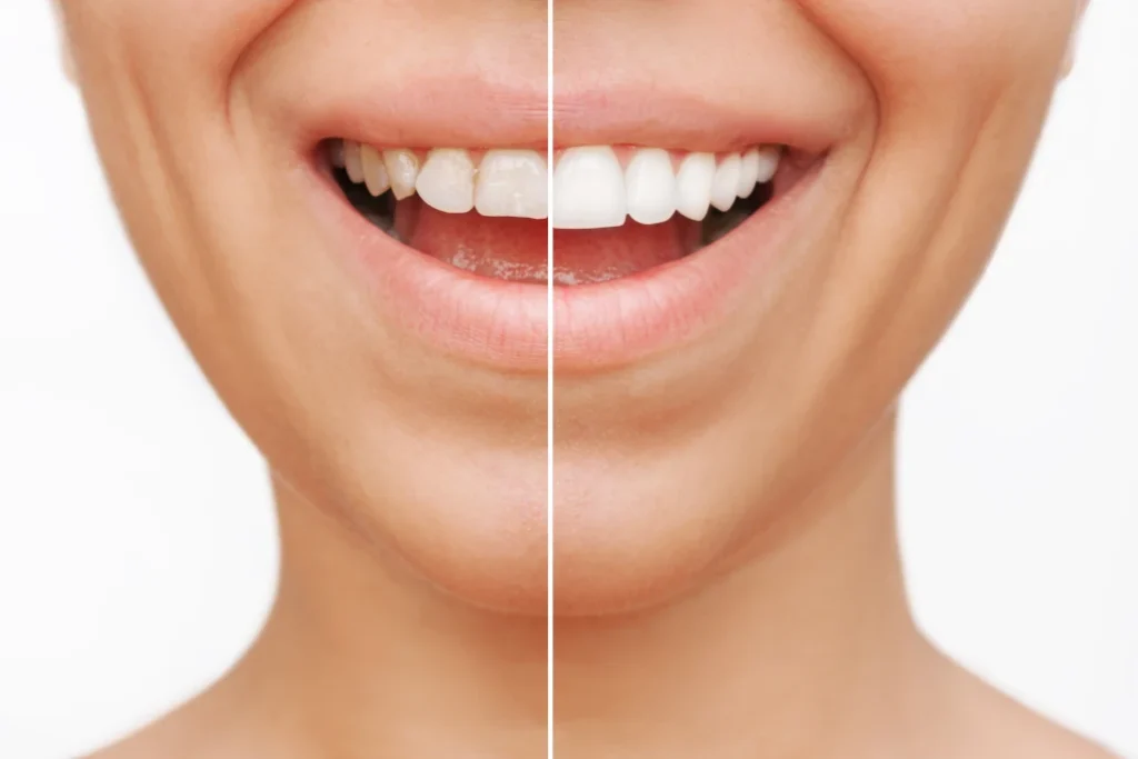 dentes antes e depois da instalação das facetas